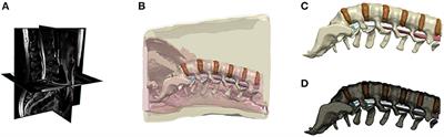 Computational modeling of posteroanterior lumbar traction by an automated massage bed: predicting intervertebral disc stresses and deformation